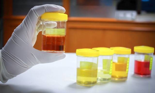 Kolor moczu może być objawem choroby. O czym świadczy kolor twojego moczu?