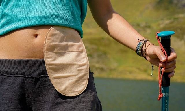 Życie ze stomią. 7 Faktów, które każdy z nas powinien znać