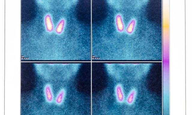 Scyntygrafia – jak działają izotopy promieniotwórcze, jakie są rodzaje i wskazania do wykonania scyntygrafii?