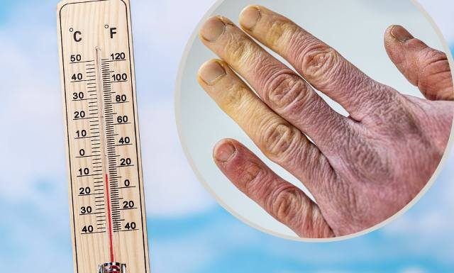 Nie trzeba siarczystych mrozów, by nabawić się odmrożeń. Na początku nawet ich nie czuć