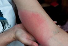 Coraz więcej zakażonych. To już nie jest problem sezonowy