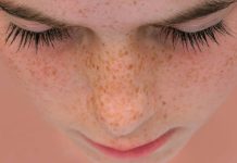 Jak powstają piegi? Najlepsze sposoby na usuwanie piegów na twarzy i zapobieganie ich powstawaniu