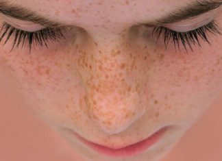 Jak powstają piegi? Najlepsze sposoby na usuwanie piegów na twarzy i zapobieganie ich powstawaniu