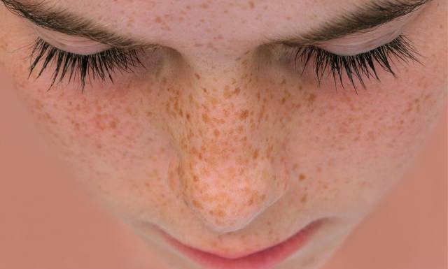 Jak powstają piegi? Najlepsze sposoby na usuwanie piegów na twarzy i zapobieganie ich powstawaniu