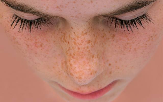 Jak powstają piegi? Najlepsze sposoby na usuwanie piegów na twarzy i zapobieganie ich powstawaniu