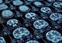 Choroby prionowe a Alzheimer i Parkinson: to łączy źle zwinięte białka