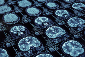 Choroby prionowe a Alzheimer i Parkinson: to łączy źle zwinięte białka