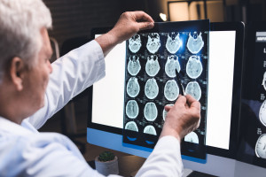 Glejak: neurochirurg o długości życia i sposobach leczenia